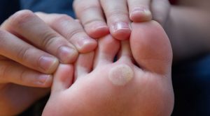 ترفندهای موثر برای درمان خانگی میخچه پا